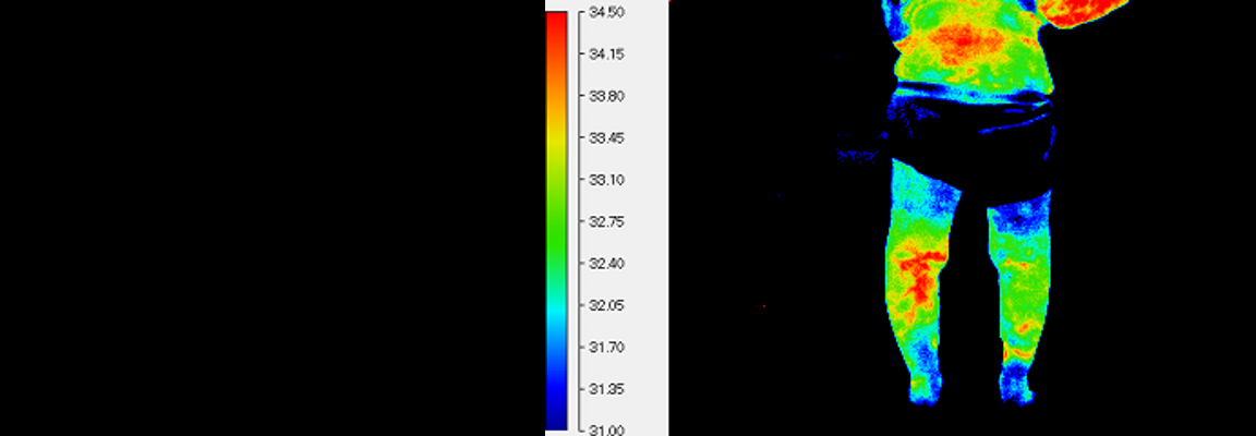 静脈瘤のサーモグラム